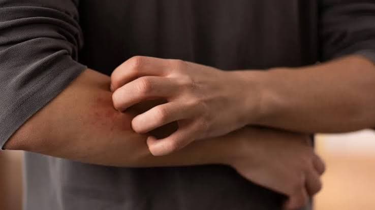 Aumento dei casi di dermatofilosi in Europa: Pregliasco rassicura sul rischio, ma avverte sui cambiamenti nel contagio